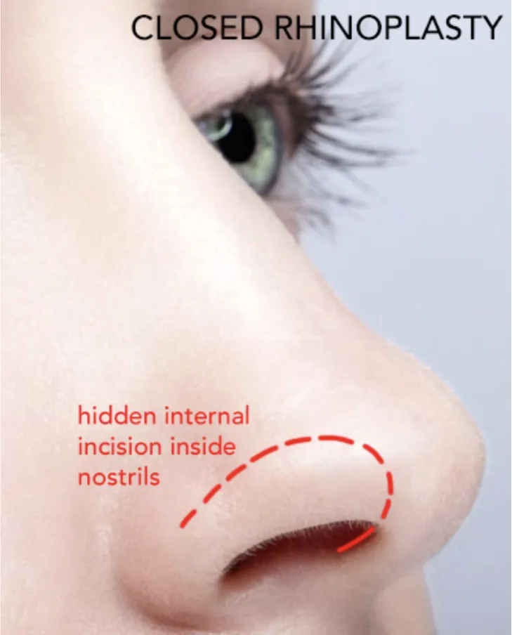 Closed Rhinoplasty in Washington DC | Sherber + Rad