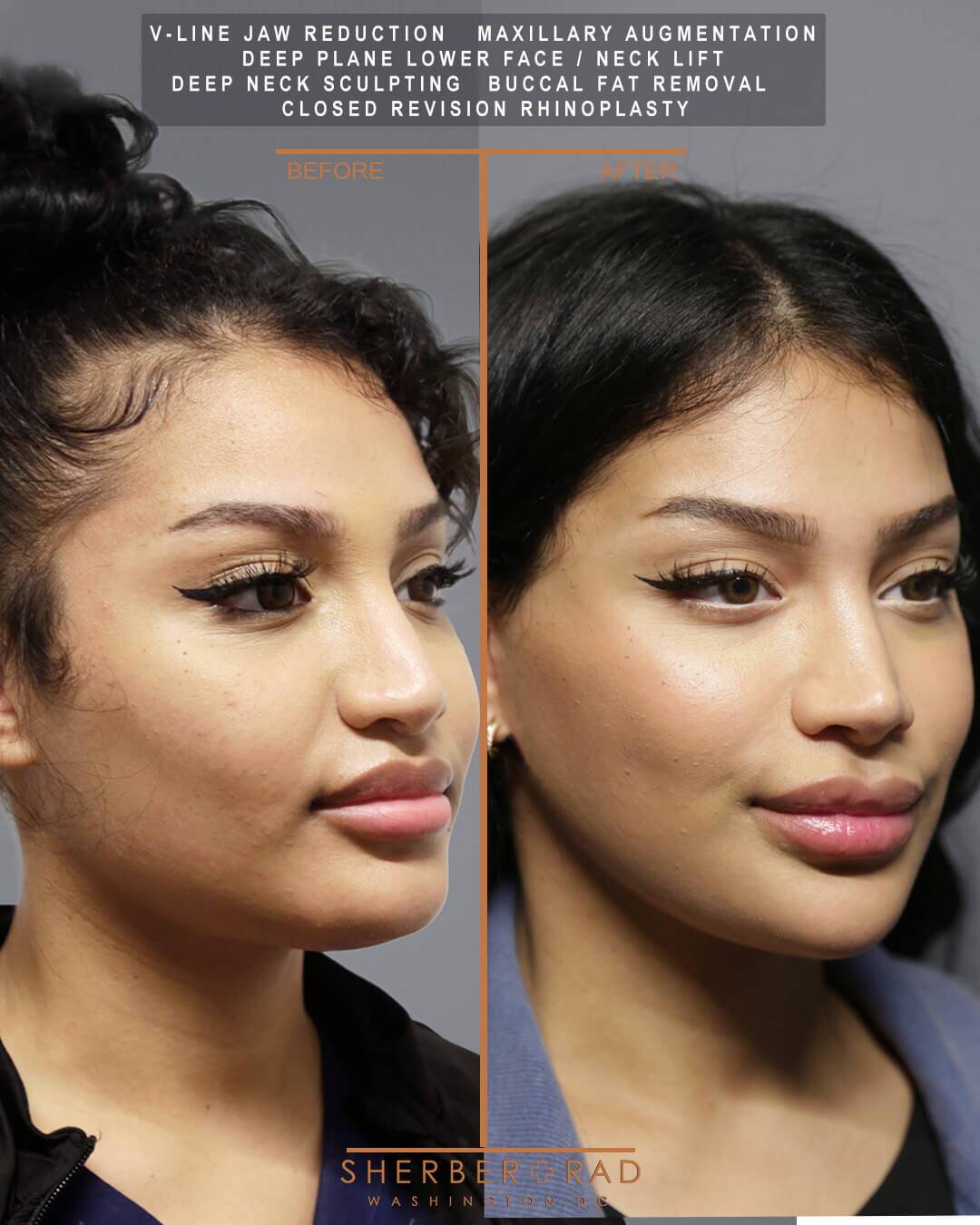 Closed Rhinoplasty in Washington DC | Sherber + Rad