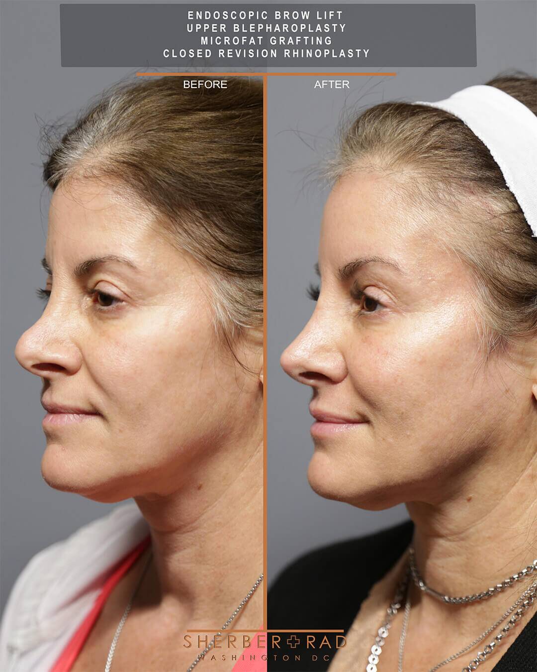 Closed Rhinoplasty in Washington DC | Sherber + Rad
