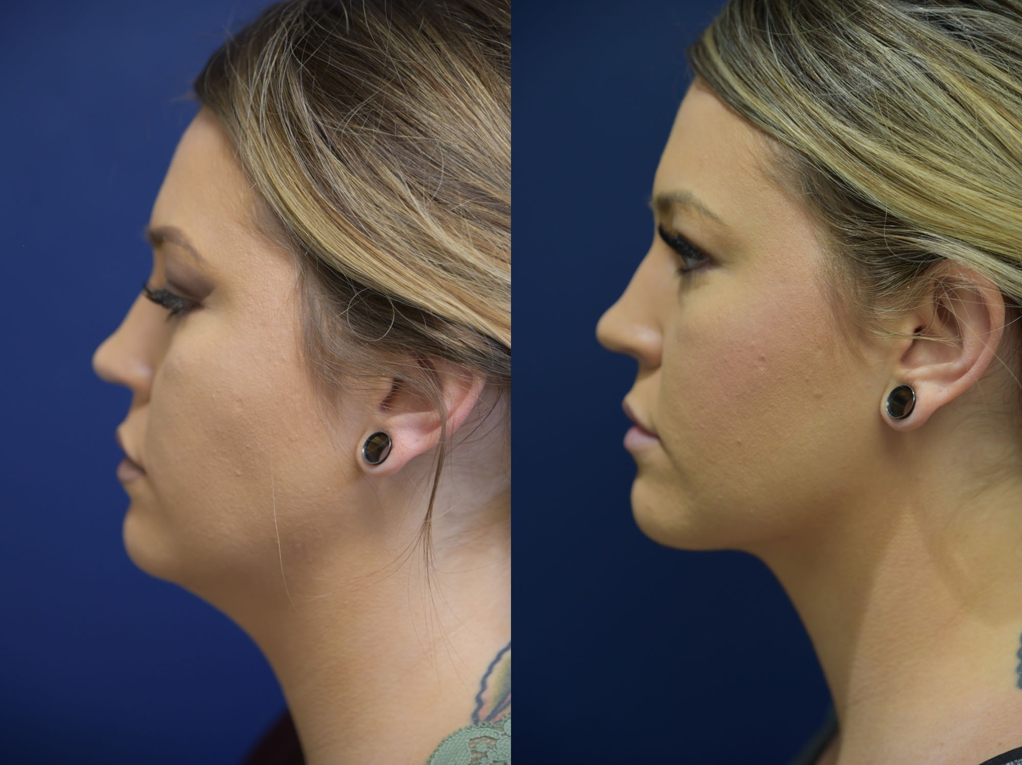 Liposuction of Neck Before and After Photo by Dr. Leveque of Gulf Coast Plastic Surgery in Pensacola, FL