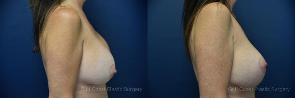 Breast Augmentation with Lift Before and After Photo by Dr. Leveque of Gulf Coast Plastic Surgery in Pensacola, FL