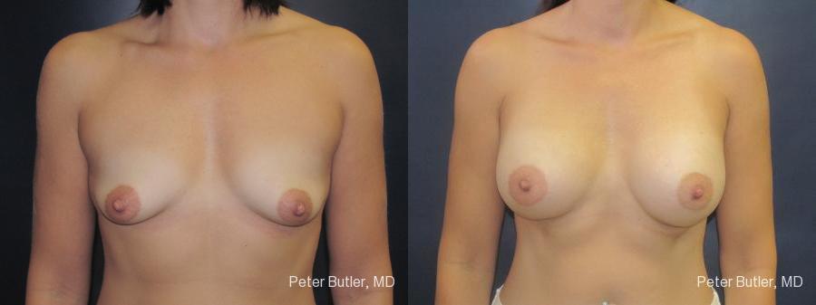 Breast Augmentation Before and After Photo by Dr. Butler in Pensacola Florida