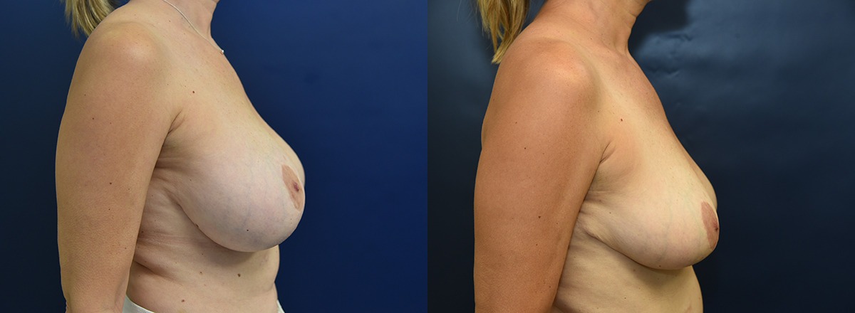 Breast Reduction Before and After Photo by Dr. Butler in Pensacola Florida