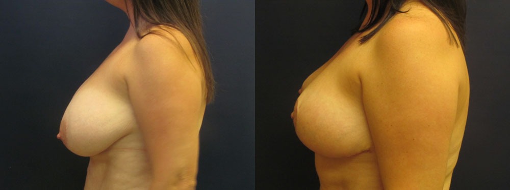 Breast Reduction Before and After Photo by Dr. Leveque of Gulf Coast Plastic Surgery in Pensacola, FL
