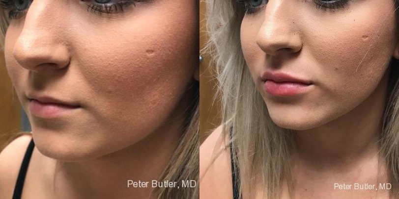 Fillers Before and After Photo by Dr. Butler in Pensacola Florida