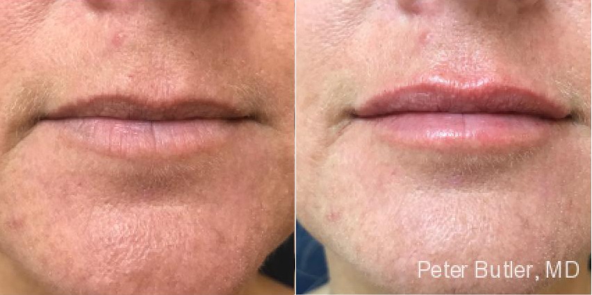 Fillers Before and After Photo by Dr. Butler in Pensacola Florida