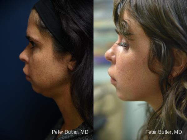 Kybella Before and After Photo by Dr. Butler in Pensacola Florida