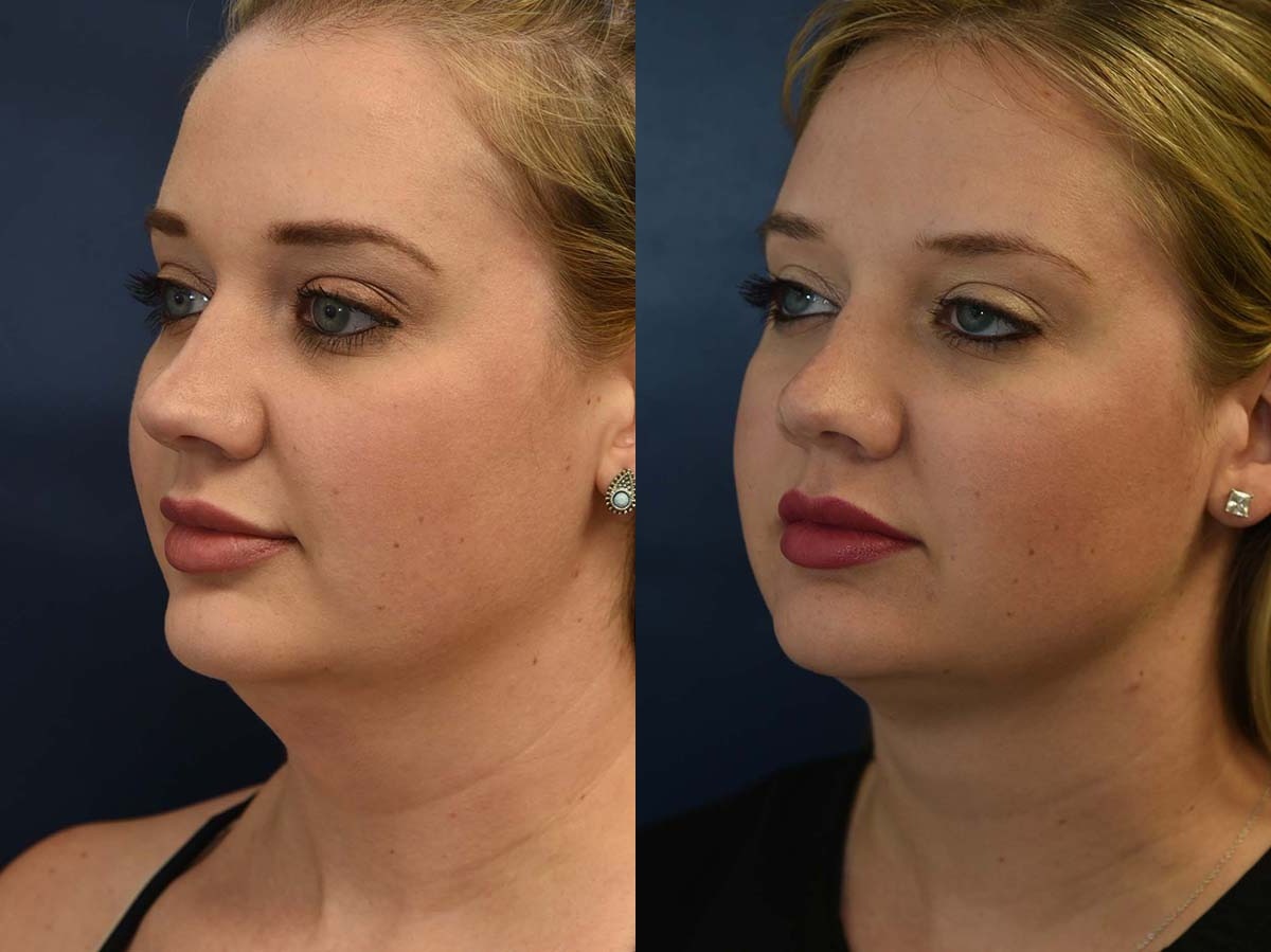 Liposuction of Neck Before and After Photo by Dr. Butler in Pensacola Florida
