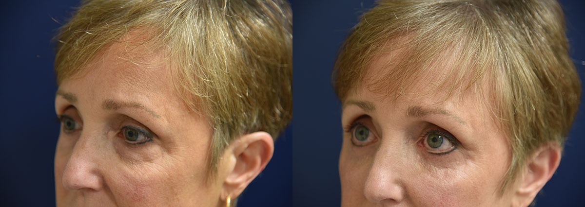 Lower Eyelid Lift Before and After Photo by Dr. Butler in Pensacola Florida