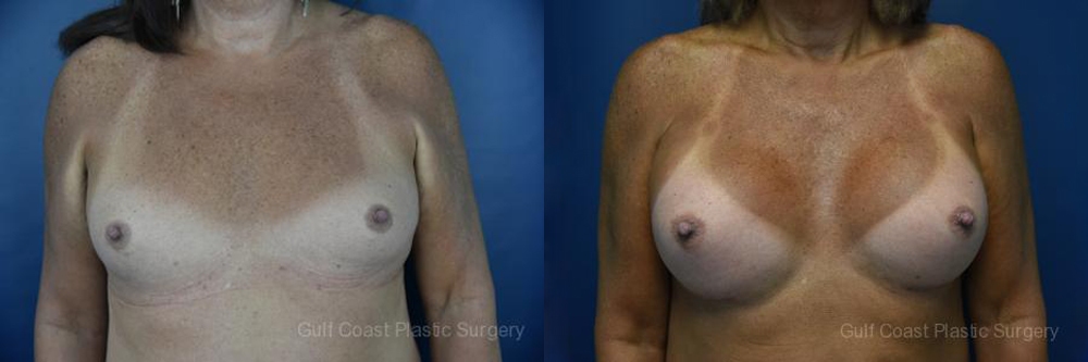 Male to Female Top Surgery Before and After Photo by Dr. Leveque of Gulf Coast Plastic Surgery in Pensacola, FL