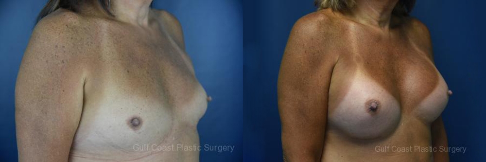 Male to Female Top Surgery Before and After Photo by Dr. Leveque of Gulf Coast Plastic Surgery in Pensacola, FL