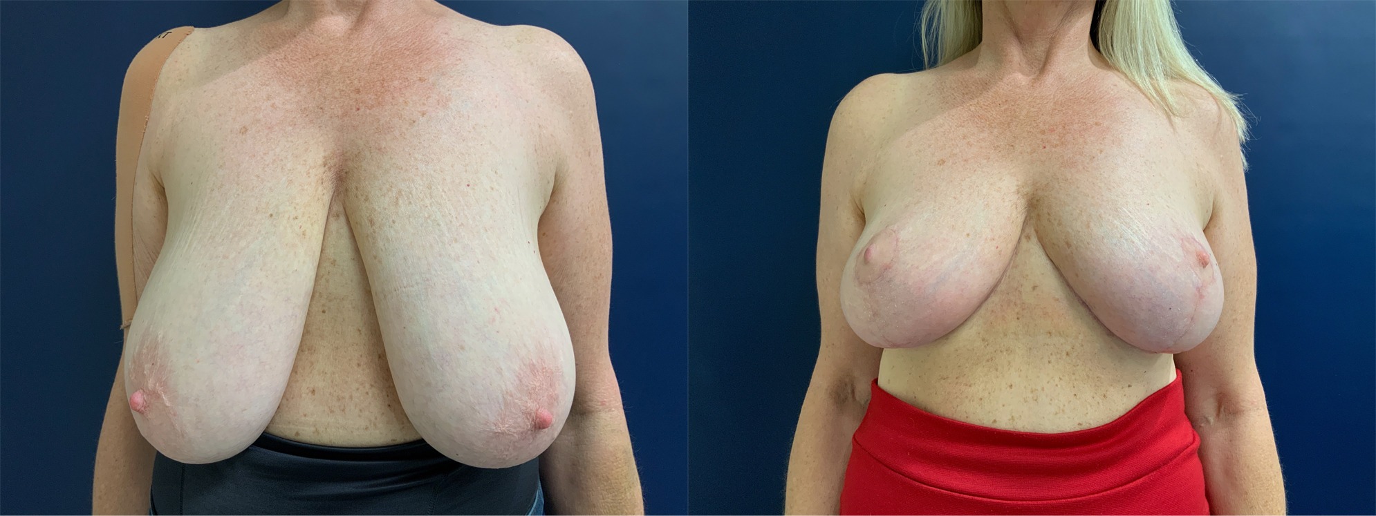 Breast Lift Before and After Photo by Dr. Patterson in Pensacola Florida