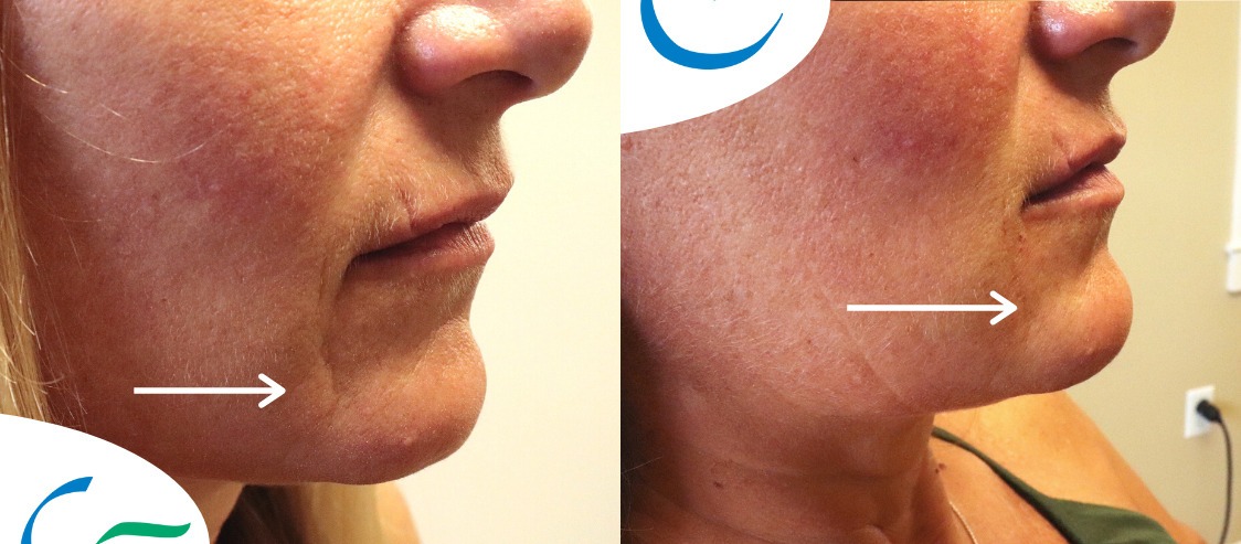 Fillers Before and After Photo by APRN in Pensacola Florida