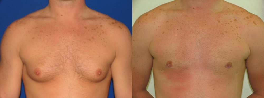 Gynecomastia Before and After Photo by Dr. Leveque of Gulf Coast Plastic Surgery in Pensacola, FL
