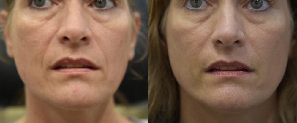 Dermal Fillers Before and After Photo by Dr. Leveque of Gulf Coast Plastic Surgery in Pensacola, FL