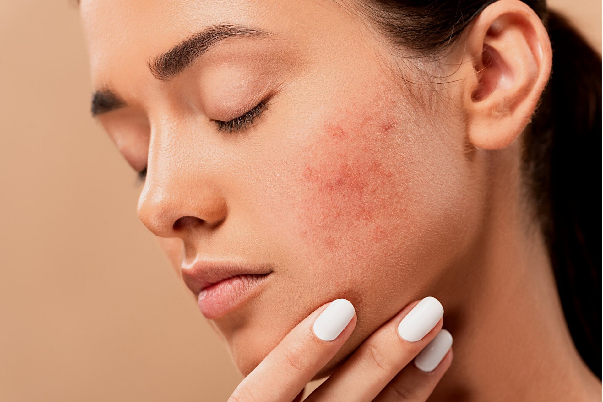 How to Treat Acne Scars