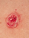 Do You Know What Skin Cancer Looks Like?