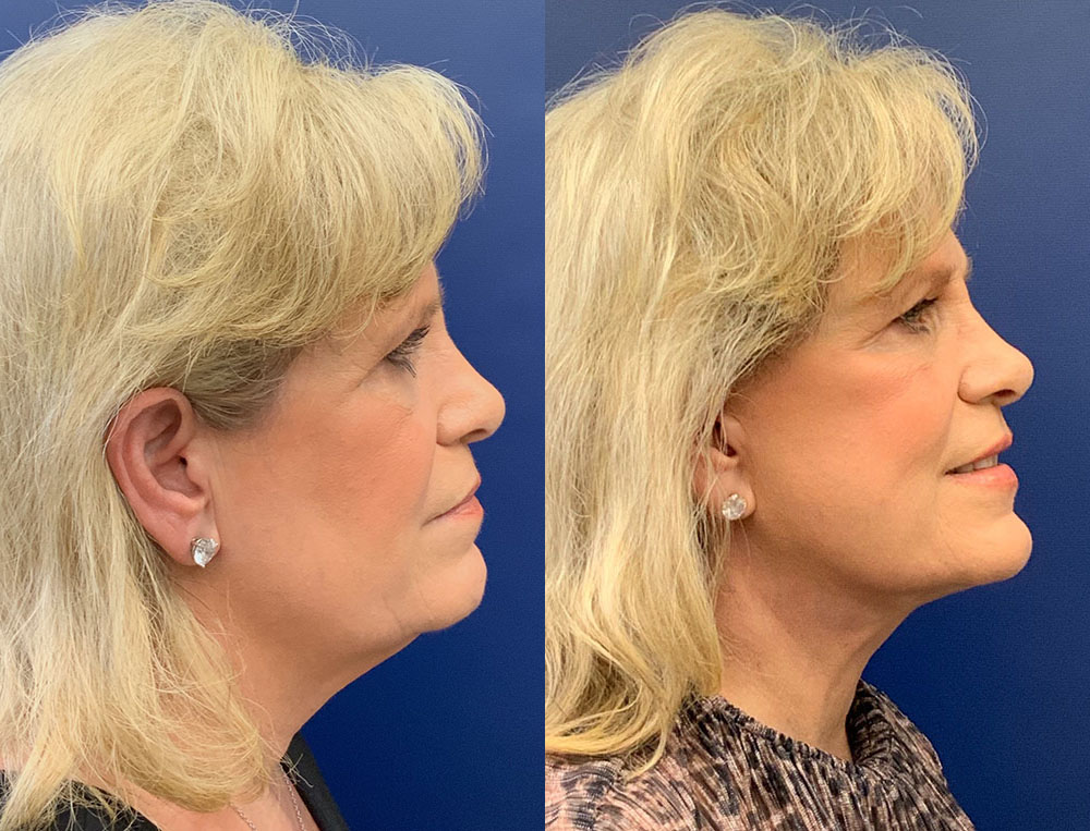Facelift Before & After by Dr. Butler in Pensacola Florida