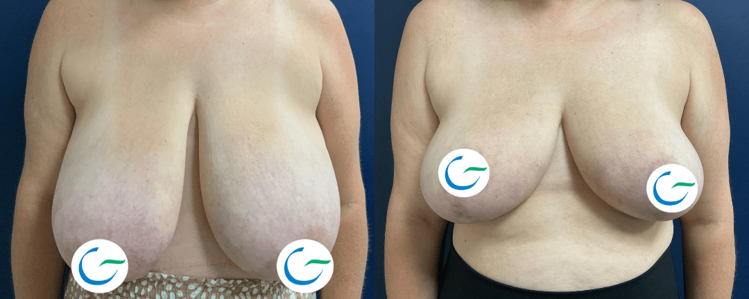 Breast Reduction Before and After Photo by Dr. Leveque in Pensacola Florida