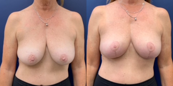 Before & After Breast Lift by Dr. Butler