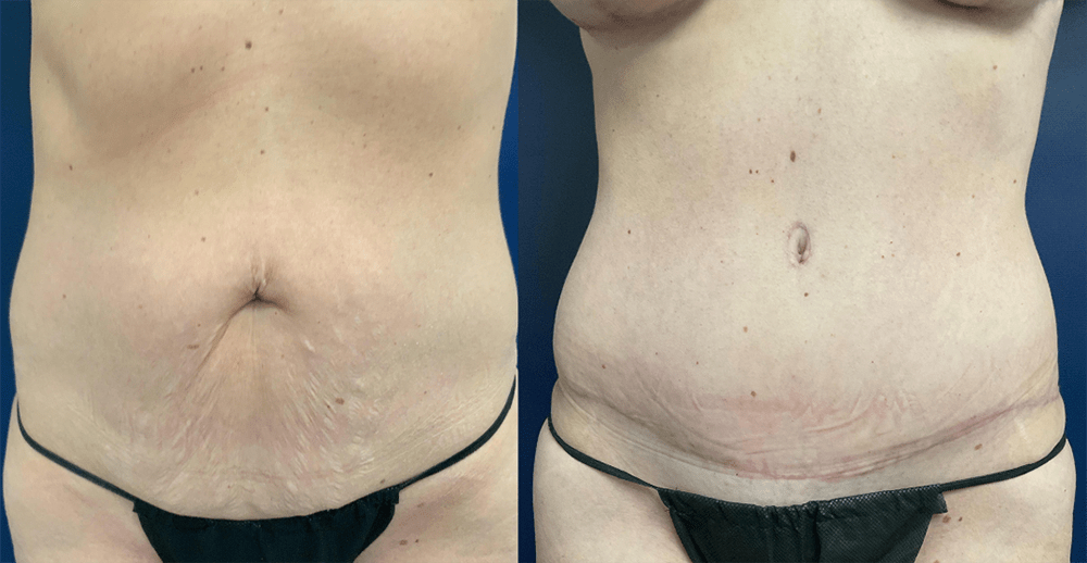 Tummy Tuck Before and After Photo by Dr. Leveque in Pensacola Florida