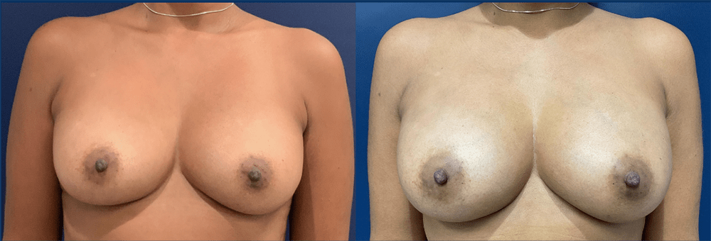 Breast Augmentation using Fat Transfer Before and After Photo by Dr. Patterson in Pensacola Florida