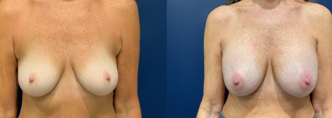 Breast augmentation done on a 61-year-old female patient, by Dr. Patterson