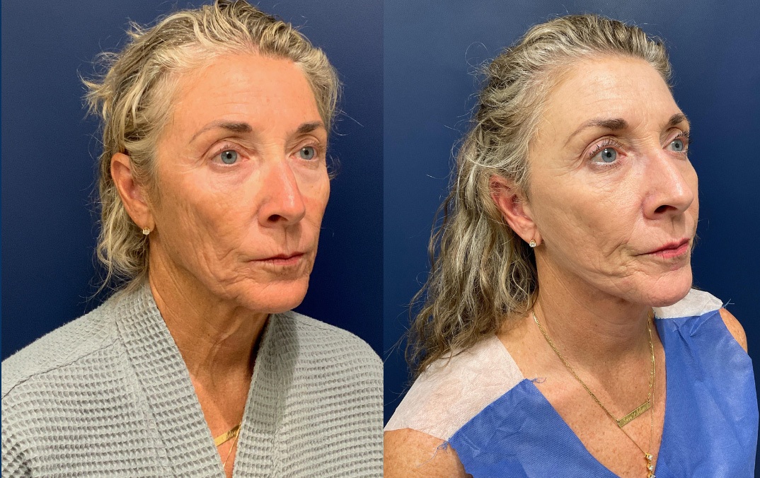 Face and neck lift done by Dr. Patterson