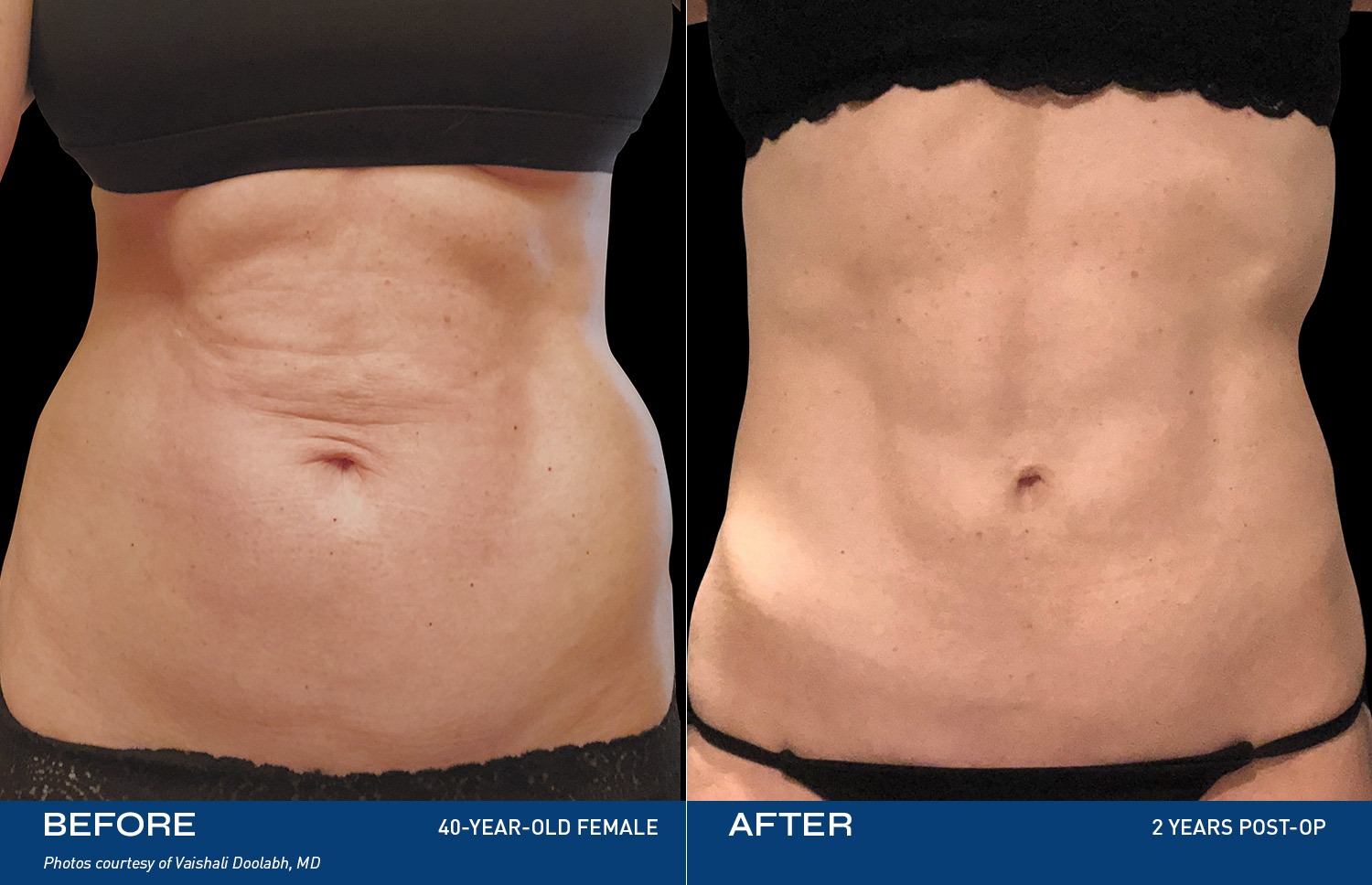 Renuvion for the Body Before & After Photos
