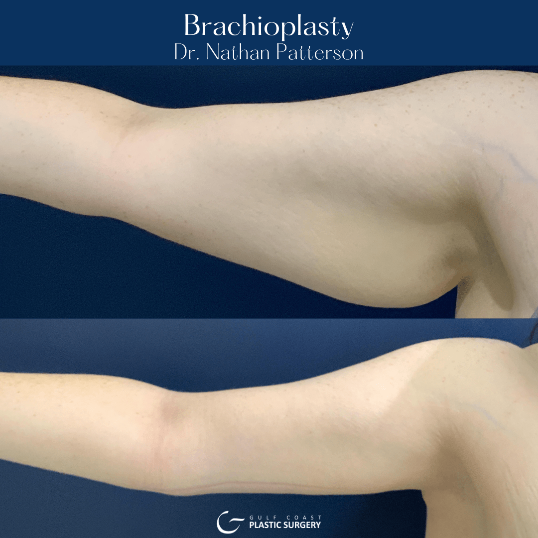 Brachioplasty Before and After Photo by Dr. Patterson of Gulf Coast Plastic Surgery in Pensacola Florida