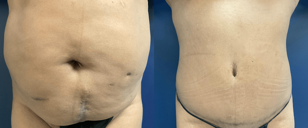 Tummy Tuck Before and After Photo by Dr. Leveque of Gulf Coast Plastic Surgery in Pensacola Florida